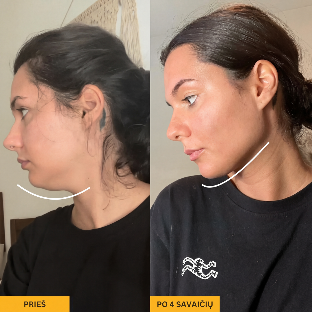TIRO™ Veido Formavimo Juosta V-Linijos
